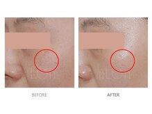 デラッセ サロン ギンザ 藤枝店(Delasser salon GINZA)/韓国iLLON シミケア白玉肌