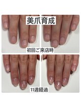 マニュコクーン(ManuCocoon)/爪育成　深爪　巻き爪　大阪市