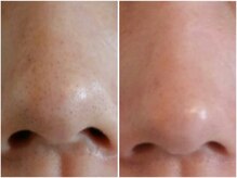 エレマヴィ(ele mavie)/ハーブピーリング/REVI/毛穴ケア