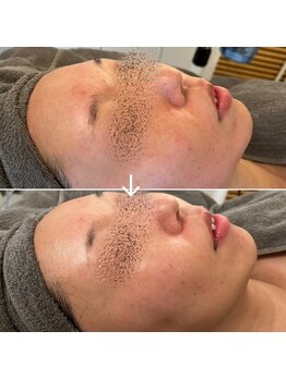 ブルームーン(Blue Moon)/REVI 3回施術