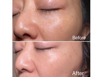 リュミエール デスポワール(Lumiere d'espoir)/原液100%臍帯幹細胞