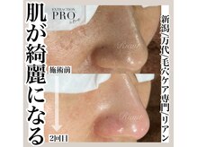 リアン(Riant)/毛穴ケアコース 