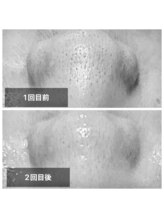 リム ビューティー(RYM BEAUTY)/ダクトピールで苺鼻ツルン