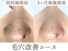 【毛穴洗浄】黒ずみ毛穴/ざらつき/皮脂/角栓詰まりを根本改善