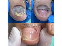 巻き爪補正店　豊橋店【巻き爪・魚の目・角質・副爪】【5月上旬オープン（予定）】/変形爪/肥厚爪