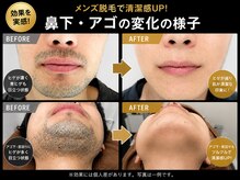 ラシンドウ 横浜鶴見店(RASHINDO)の雰囲気（【髭脱毛の効果】男性の剛毛に特化したハイパワー脱毛で激変）