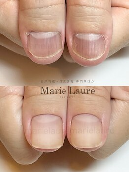 マリーロール 淀屋橋本店(Marie Laure)/深爪矯正/自爪育成/ネイルケア