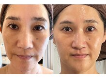 サロン ド クーラ(Salon de CURA)/別人級のたるみ改善★小顔造顔！