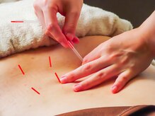 灸スタイル 掛川本院(灸Style)/腰痛の鍼施術
