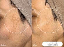 フォンビューティー(fon beauty)/しみケア１ヶ月・2回