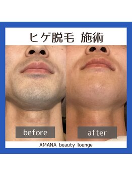 アマナ(AMANA)/【メンズ】ヒゲ脱毛驚きの効果!