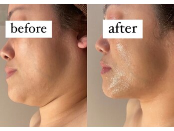 ウィズルーチェ 神栖店(with luce)/お顔の脂肪をごっそり！小顔効果