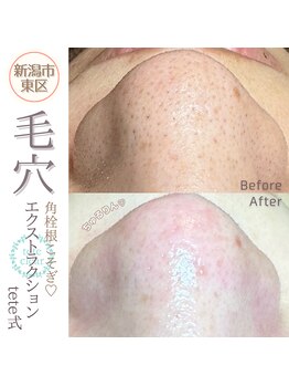 ソマリ(SOMALI)/【毛穴洗浄&ヒト幹導入】