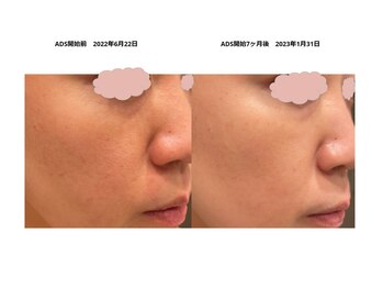 ユーブルーム(youbloom)/毛穴も目立たなく☆