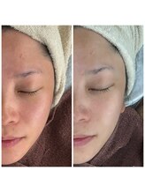 カラット(CARAT)/光フェイシャル&パック