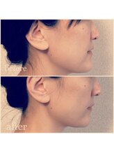 アールイー(Re:)/あごが気になる方