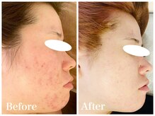 ノア 新宿(Noa)/ハーブピーリング＋マシン 6回