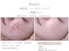 【変わるきっかけは1回目】から韓国発、ハーブピーリング♪初回限定¥13000
