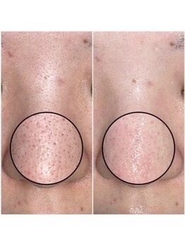 ソワンプラス(soin+)の写真/水流の力で毛穴汚れを優しくオフ！速攻ツルツル、触りたくなるクリアな素肌へ。