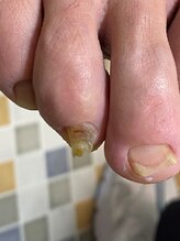 フットメンテ 巻き爪矯正センター 南浦和/肥厚爪