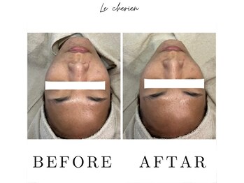 ルシェリア(Le cherien)/小顔リフトアップ