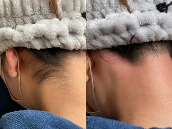 エビアス 旭川豊岡(evias)/レディース店　うなじ脱毛