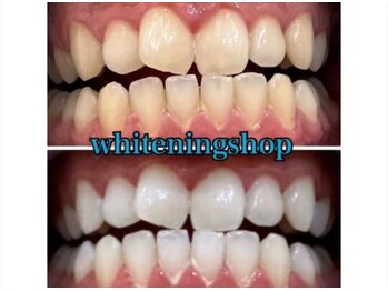 ホワイトニングショップ 鳥取店/ホワイトニングビフォーアフター