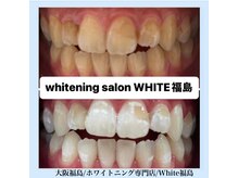 ホワイトニングサロン ホワイト(WHITE)/セルフホワイトニング/大阪/福島