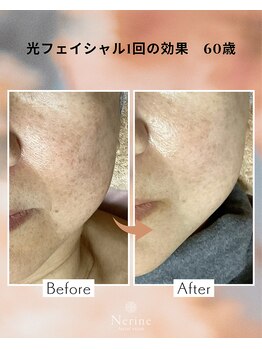 ネリネ(Nerine)/光フェイシャル1回の効果