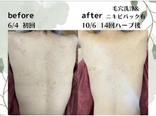 ベルーテエッセンスの雰囲気（ハーブピーリングや毛穴洗浄で根本肌質改善！背中ニキビケアも◎）
