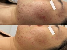 ラポーム(La paume)/ニキビケア・赤みでお悩みの方　
