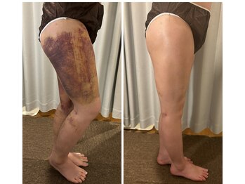 アヌヘア(Anuhea)/京都で1番のインディバ術ケア