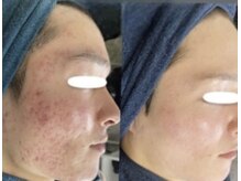 ムーンリズム(Moonlism)/【TIPハーブ症例】ニキビ・跡