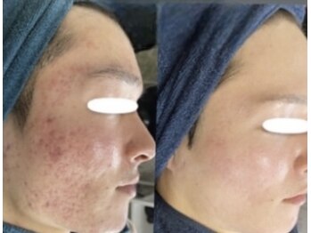 ムーンリズム(Moonlism)/【TIPハーブ症例】ニキビ・跡