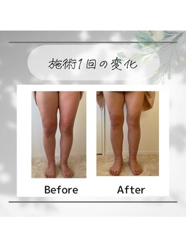 クラッシー(Classy)/むくみ改善し、美脚へ