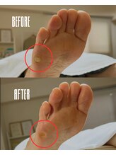 おん/出っ張ったウオノメ