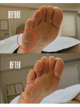 おん/出っ張ったウオノメ