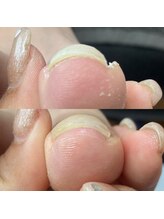 シャドウ(shadow)/痛い陥入爪が、、