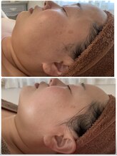 イルソーレ(IL Sole)/肌悩みはハーブピーリングでケア