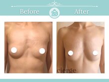 美人バスト 南森町店/バストアップ◇症例◇