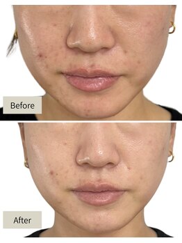 シャムリー(SHAMRY)/TROIAREUKE／SEN管理(ニキビ)