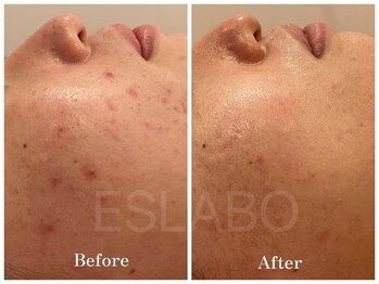 エスラボオオサカ 梅田(エスラボOSAKA)/肌質改善/ハーブピーリング大阪