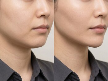 クララエステティック カシハラ(CLALA aesthetic Kashihara)の写真/【フォト美顔コース4400円】口元のもたつきも整え、驚くほどツルツルな引き締まった透明肌へ♪