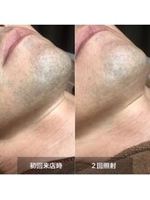 リムル(REMURU)/ひげ脱毛2回照射