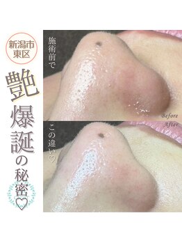 ソマリ(SOMALI)/【毛穴洗浄&ヒト幹導入】