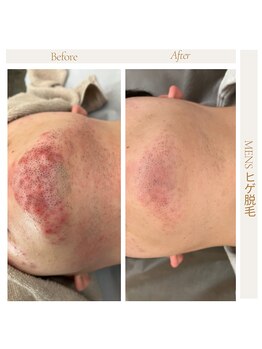 ラポール(rappore;)/メンズヒゲ脱毛