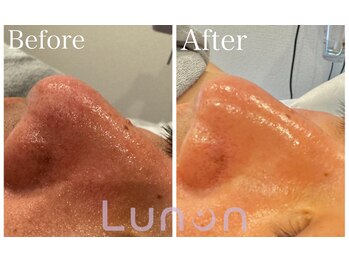 ルノン(Lunon)/毛穴洗浄ハイドロ