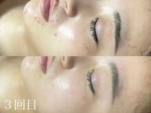 ホワイトアクア 池袋店(WHITE AQUA)/ハーブピーリング/毛穴洗浄/池袋