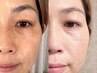 【老け顔の原因…たるみ】ふっくら肌に再び出会う。業界初の羊膜フェイシャル