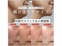 太陽と月の雰囲気（憧れの小顔＆美肌が叶う★炭酸ガスパック+小顔調整+リンパ首肩腕）